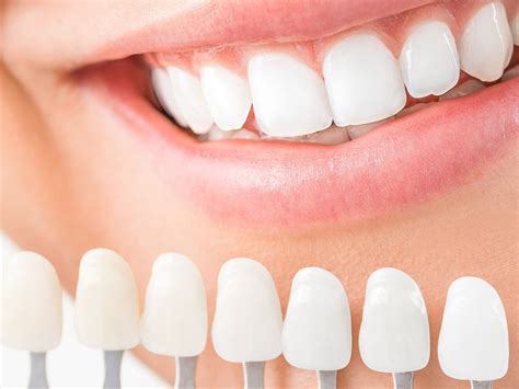 composite veneers how long do they last|Composite Veneers Pros & Cons, Procedure, Cost, and .